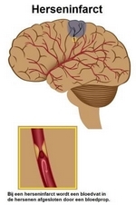 Wat is een herseninfarct