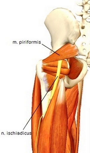 dode-billen-syndroom of het piriformis-syndroom