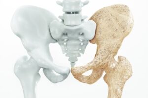 osteoporose en de overgang