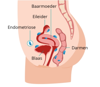 hoe herken je endometriose?