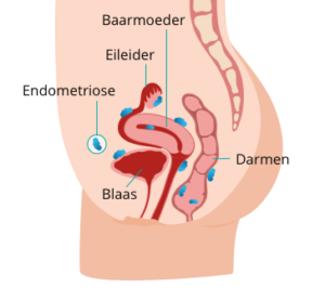 hoe herken je endometriose?